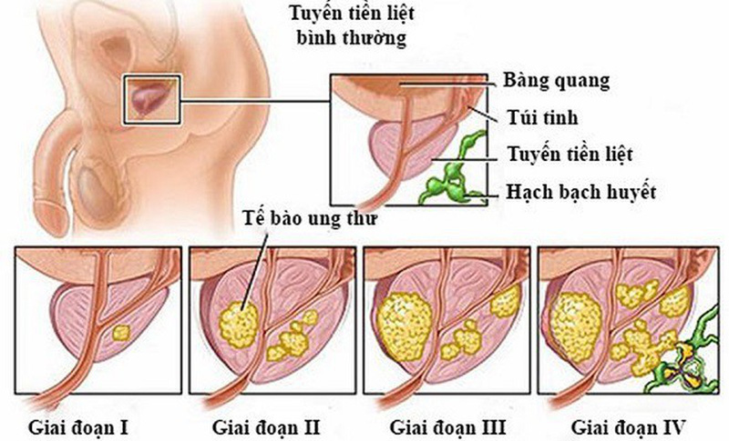 Ung thư tuyến tiền liệt - Hình ảnh minh họa